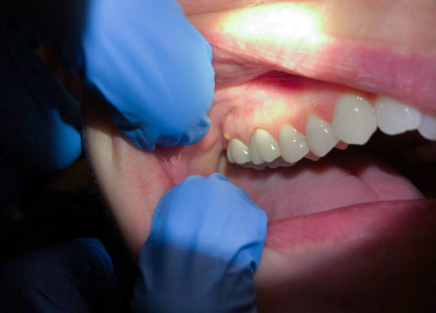 Best Emergency Dentist for Lost Fillings or Crowns in St Robert, MO