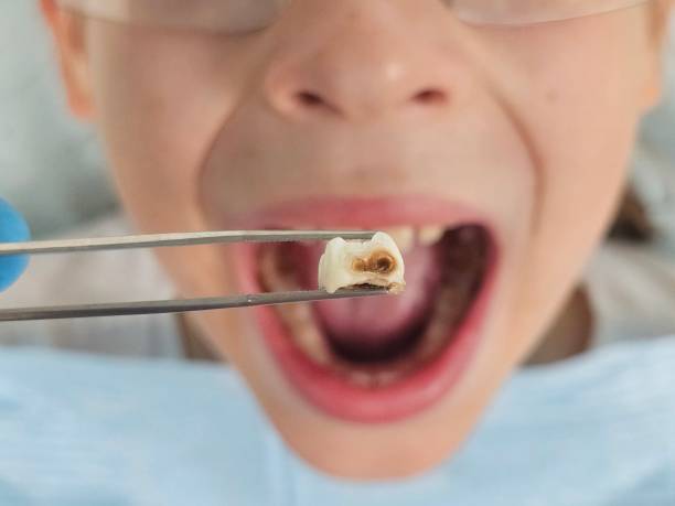 Best Broken or Cracked Tooth Emergency Dentist in St Robert, MO